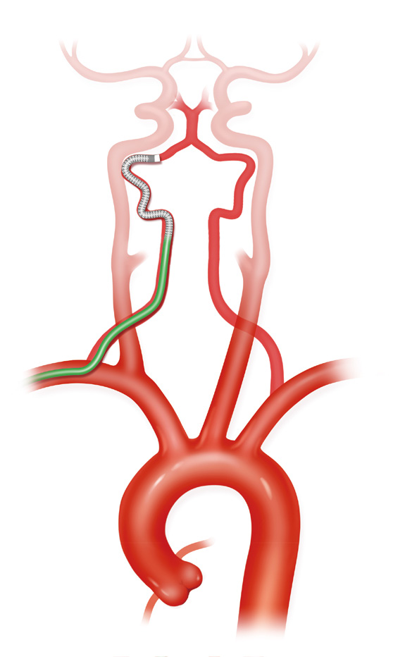 泥鳅导丝怎么用上行道简，桡遇而安丨REST经桡中间导管简化技术详解_https://www.jmylbn.com_新闻资讯_第37张