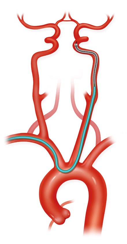 泥鳅导丝怎么用上行道简，桡遇而安丨REST经桡中间导管简化技术详解_https://www.jmylbn.com_新闻资讯_第28张