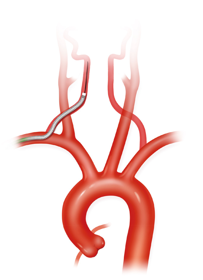 泥鳅导丝怎么用上行道简，桡遇而安丨REST经桡中间导管简化技术详解_https://www.jmylbn.com_新闻资讯_第35张
