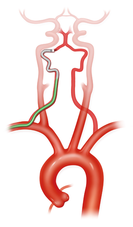 泥鳅导丝怎么用上行道简，桡遇而安丨REST经桡中间导管简化技术详解_https://www.jmylbn.com_新闻资讯_第36张