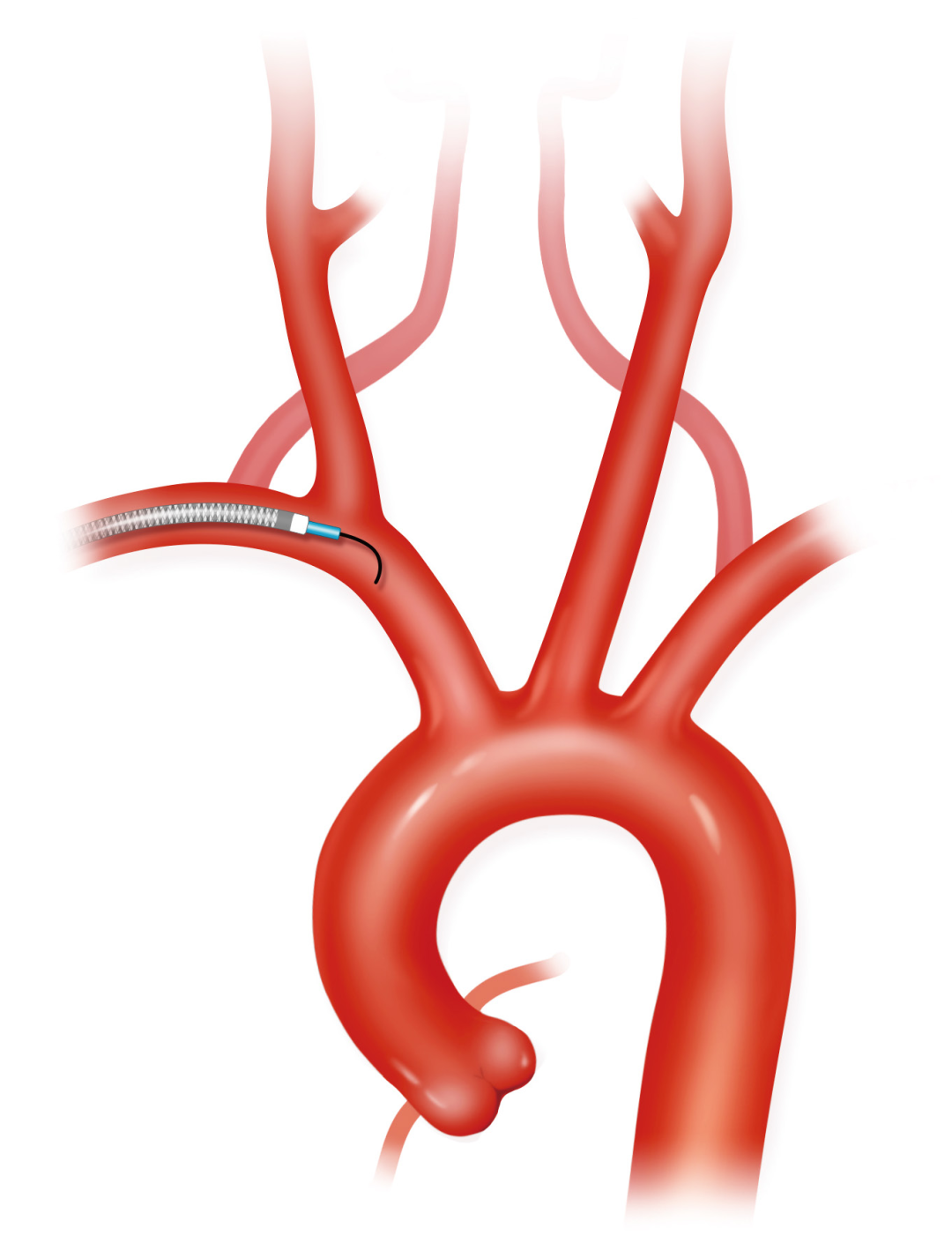 泥鳅导丝怎么用上行道简，桡遇而安丨REST经桡中间导管简化技术详解_https://www.jmylbn.com_新闻资讯_第9张