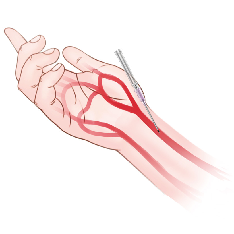 泥鳅导丝怎么用上行道简，桡遇而安丨REST经桡中间导管简化技术详解_https://www.jmylbn.com_新闻资讯_第4张