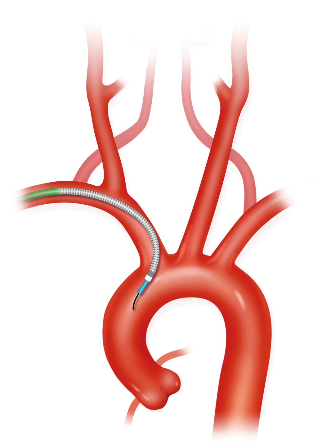 泥鳅导丝怎么用上行道简，桡遇而安丨REST经桡中间导管简化技术详解_https://www.jmylbn.com_新闻资讯_第21张