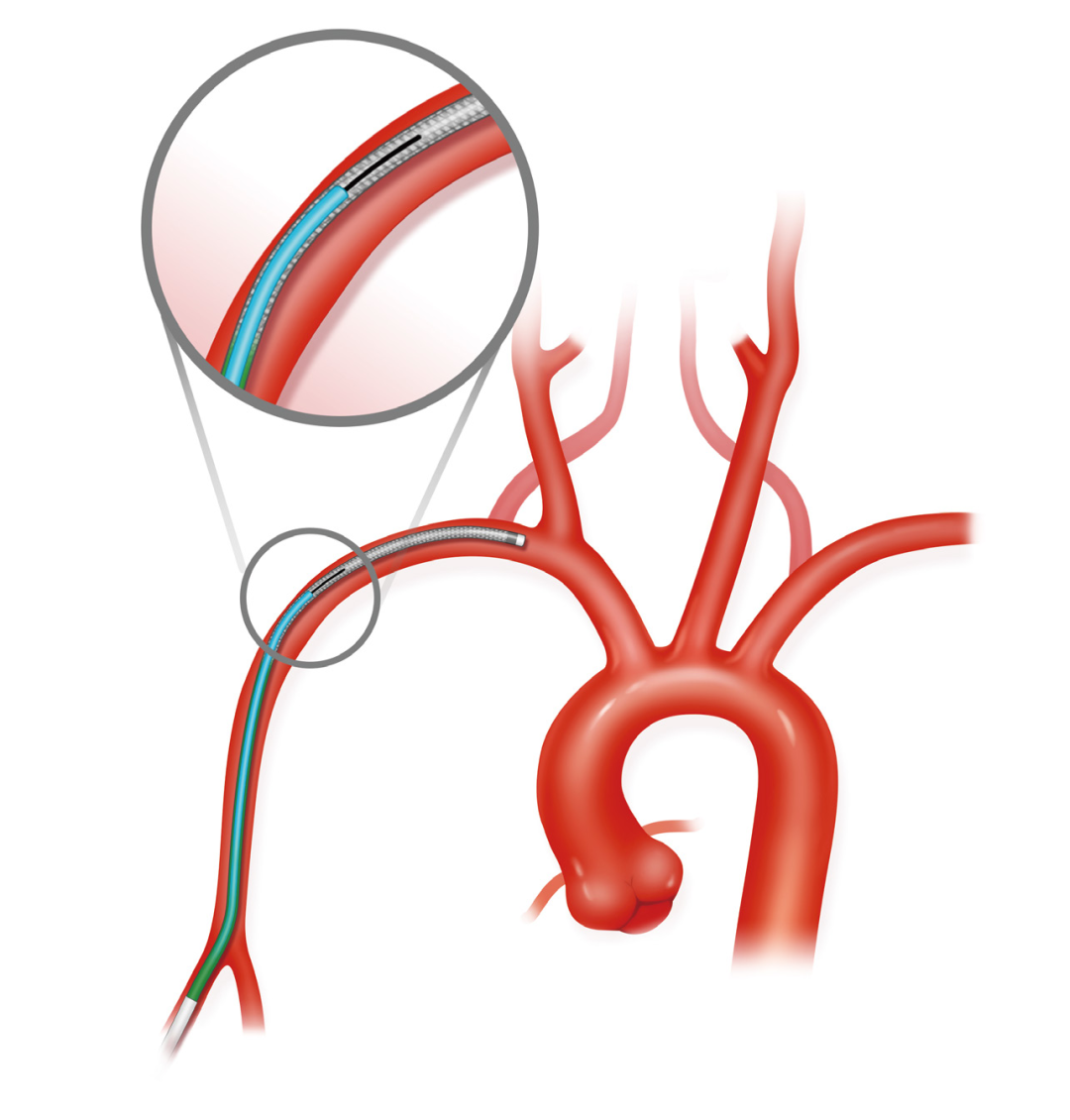 泥鳅导丝怎么用上行道简，桡遇而安丨REST经桡中间导管简化技术详解_https://www.jmylbn.com_新闻资讯_第20张