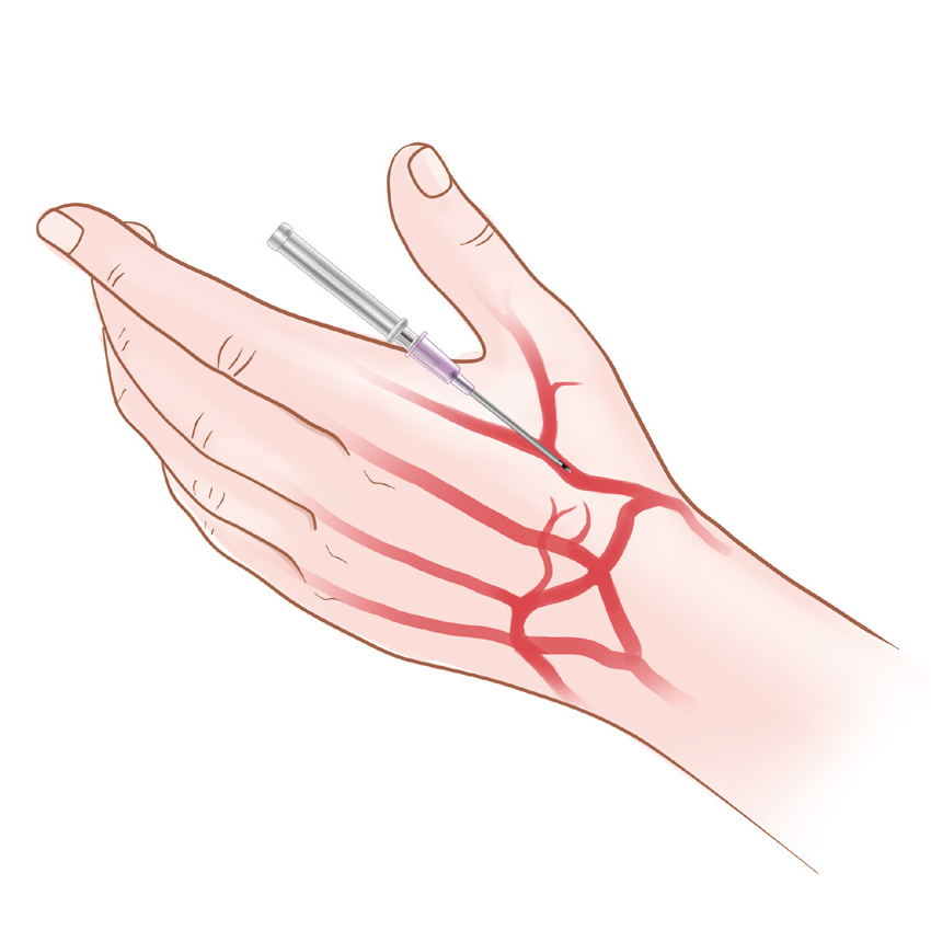 泥鳅导丝怎么用上行道简，桡遇而安丨REST经桡中间导管简化技术详解_https://www.jmylbn.com_新闻资讯_第6张