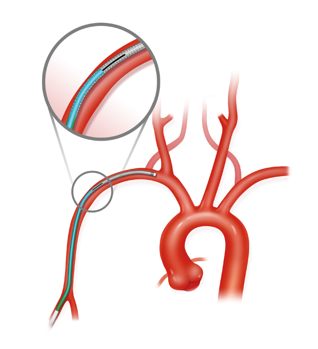泥鳅导丝怎么用上行道简，桡遇而安丨REST经桡中间导管简化技术详解_https://www.jmylbn.com_新闻资讯_第8张