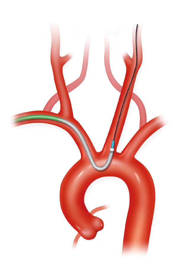泥鳅导丝怎么用上行道简，桡遇而安丨REST经桡中间导管简化技术详解_https://www.jmylbn.com_新闻资讯_第25张