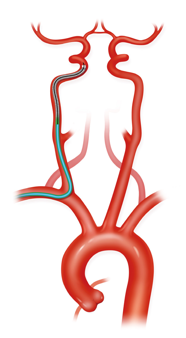 泥鳅导丝怎么用上行道简，桡遇而安丨REST经桡中间导管简化技术详解_https://www.jmylbn.com_新闻资讯_第15张