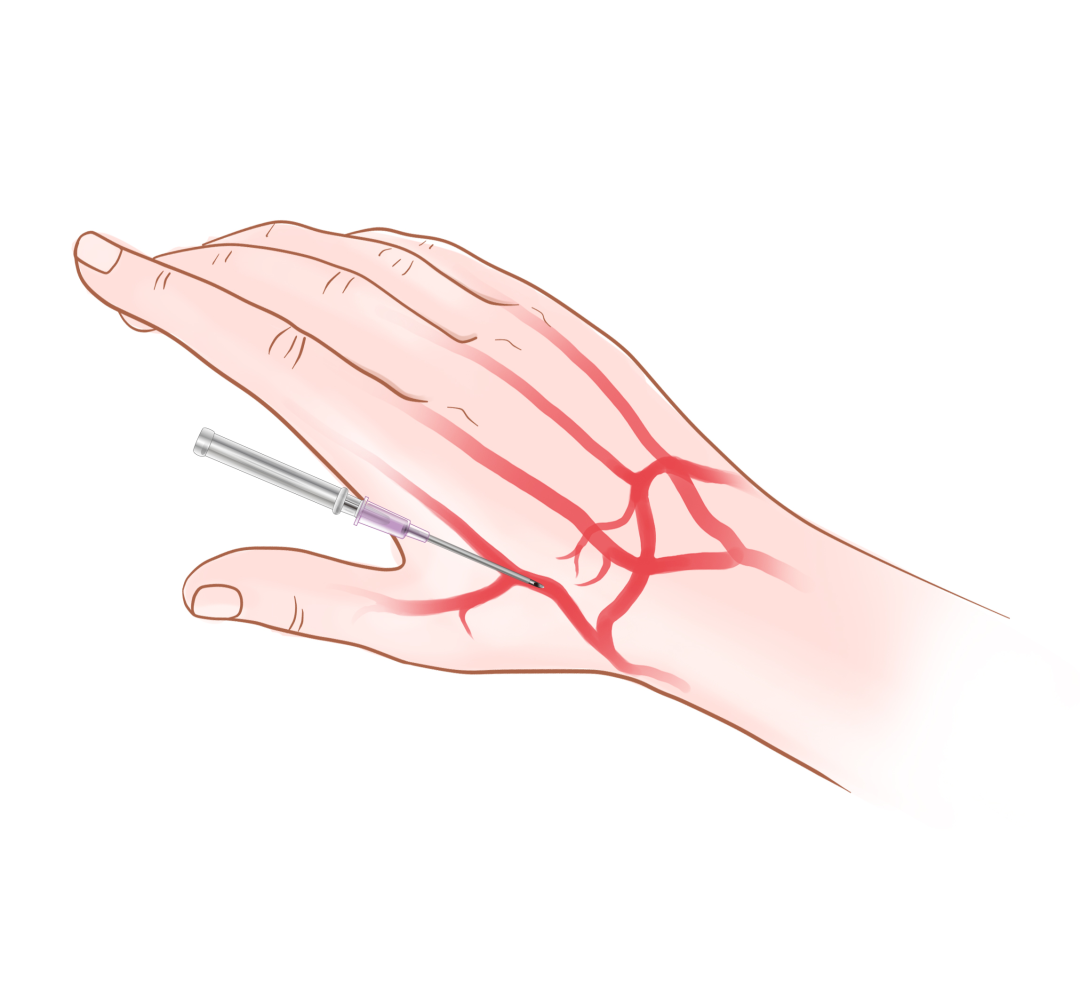 泥鳅导丝怎么用盘途问路，桡行而至丨ATTACH经桡中间导管成袢技术详解_https://www.jmylbn.com_新闻资讯_第6张