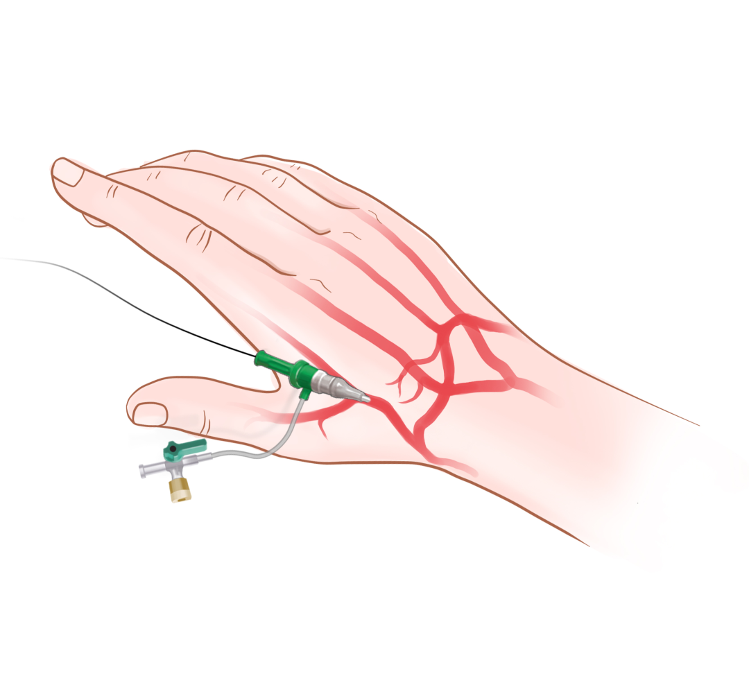 泥鳅导丝怎么用盘途问路，桡行而至丨ATTACH经桡中间导管成袢技术详解_https://www.jmylbn.com_新闻资讯_第7张
