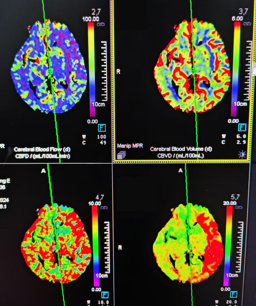 动脉长鞘怎么置入有励可说｜Locaste 088励楷长鞘及Tarvos微导丝在左侧大脑中动脉闭塞取栓术中的应用_https://www.jmylbn.com_新闻资讯_第6张