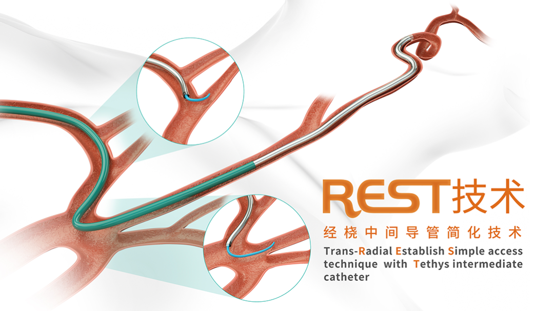 泥鳅导丝怎么用上行道简，桡遇而安丨REST经桡中间导管简化技术详解_https://www.jmylbn.com_新闻资讯_第2张