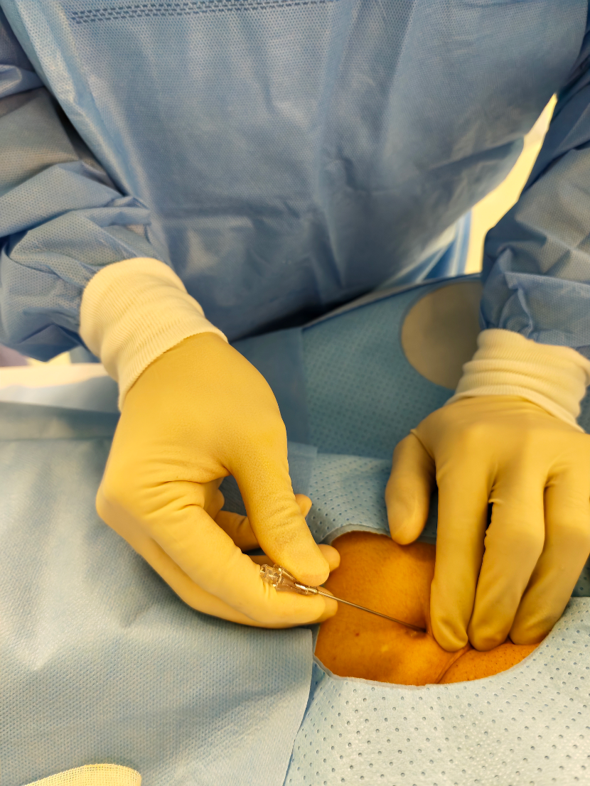 怎么上穿刺鞘七点一“课”·第1期｜股动脉穿刺置鞘术：技术细节（1）完整穿刺过程_https://www.jmylbn.com_新闻资讯_第2张