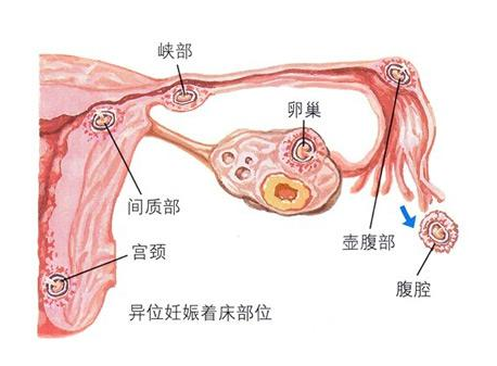 试管知识 | “鹊桥”积水也会影响试管成功率！