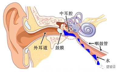 耳闷 耳堵 听力下降 当心 分泌性中耳炎 医者情 微信公众号文章阅读 Wemp