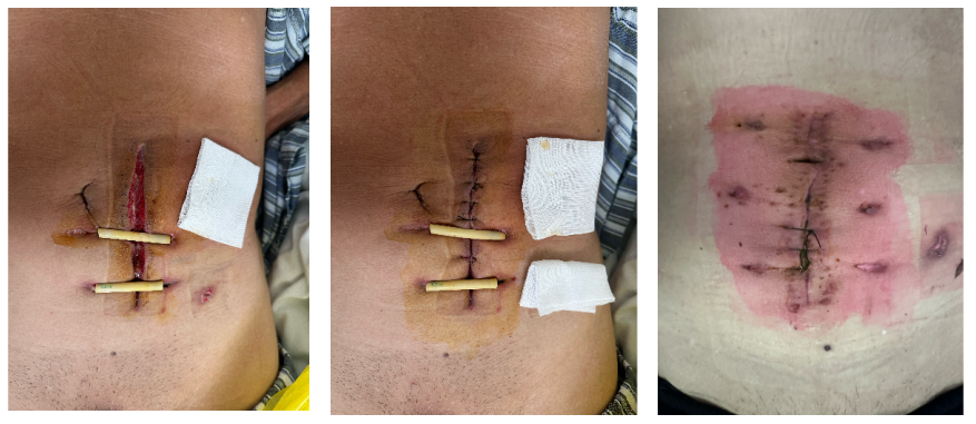 怎么促进vsd伤口愈合【亭医·医疗】VSD封闭式负压引流技术，慢性创面患者的福音_https://www.jmylbn.com_新闻资讯_第14张