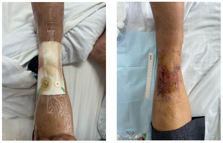 怎么促进vsd伤口愈合【亭医·医疗】VSD封闭式负压引流技术，慢性创面患者的福音_https://www.jmylbn.com_新闻资讯_第15张