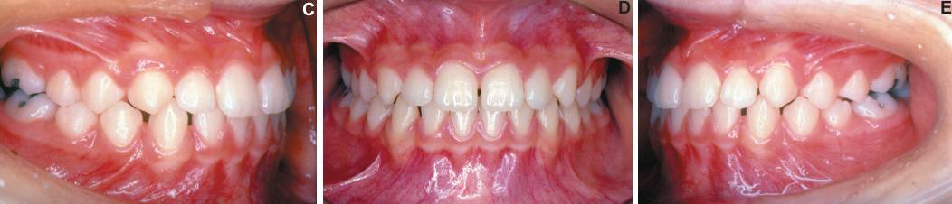 正畸· 文献综述|安氏iii类错合畸形早期治疗:10年临床回访