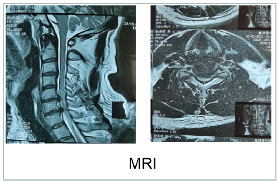20天，他从瘫痪在床到站立行走……