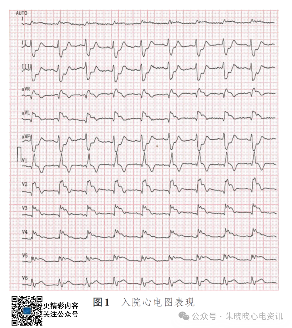 左主干急性完全闭塞的心电图特征
