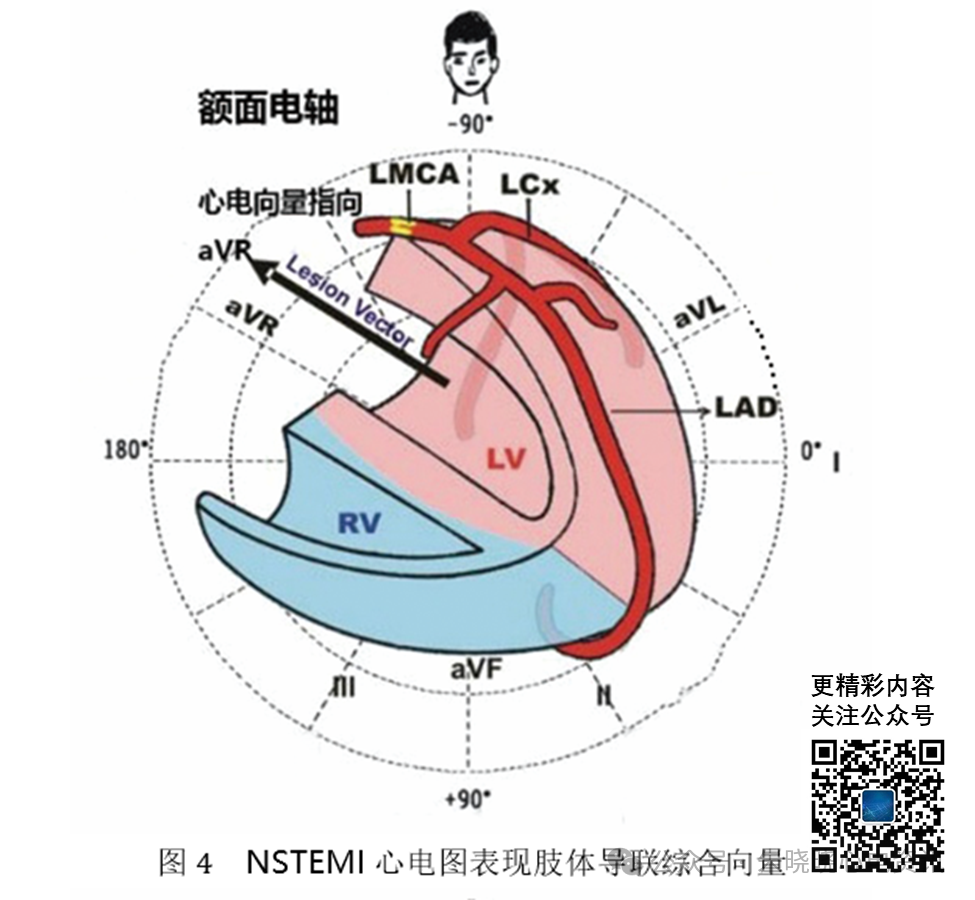 左主干急性完全闭塞的心电图特征