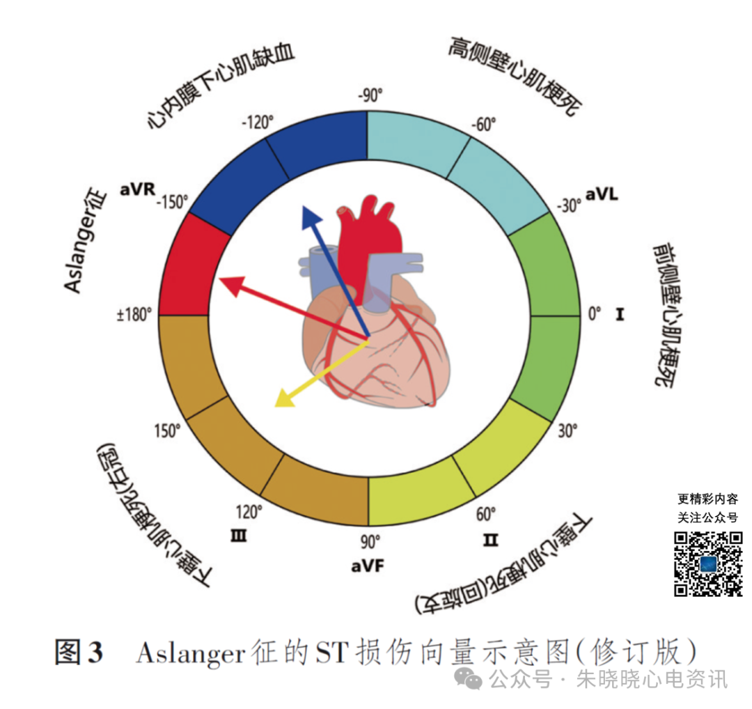 解读急性下壁心肌梗死的Aslanger征