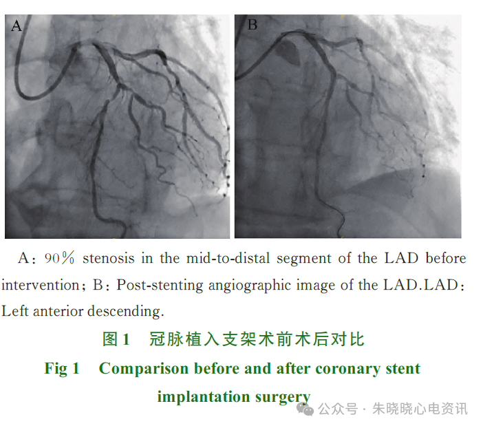 多发性肌炎误诊为非ST