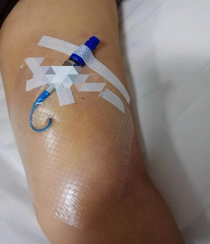 picc导管是什么材质带您走近PICC_https://www.jmylbn.com_新闻资讯_第5张