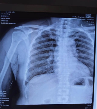 picc导管是什么材质带您走近PICC_https://www.jmylbn.com_新闻资讯_第3张