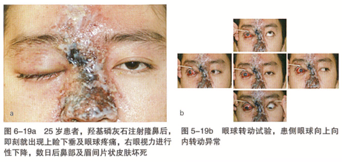 微整形注射并发症 骨粉和微晶瓷的并发症及治疗方法 微整形学 微信公众号文章阅读 Wemp