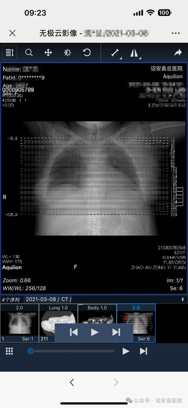 为什么x光片用胶片【便民服务】诏安县医院公众号可以自助查看X光片和查阅CT、MIR检查结果啦！_https://www.jmylbn.com_新闻资讯_第18张
