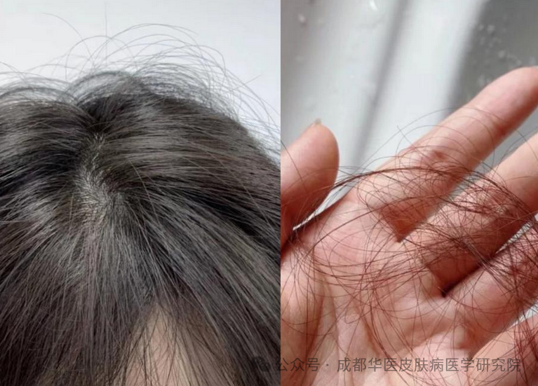 头发出油脱发看什么科？专业指南帮你轻松解决*告别头发出油和脱发烦恼，从选择正确的科室开始