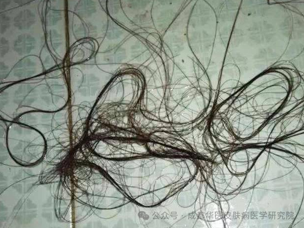 掉头发厉害是身体哪里出现问题了？发丝的秘密：探索掉发背后的健康警示,**你的头发，讲述着身体健康的故事