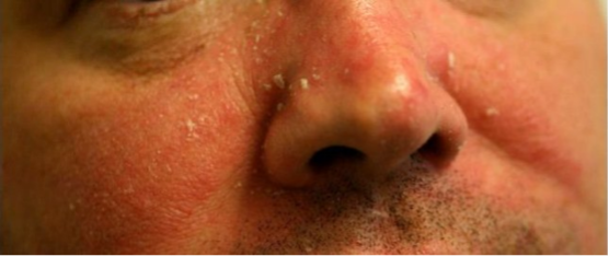 有一种痒叫脂溢性皮炎！治疗护理全攻略来了