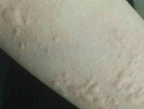 退热药的「过敏反应」，你一定得了解下！