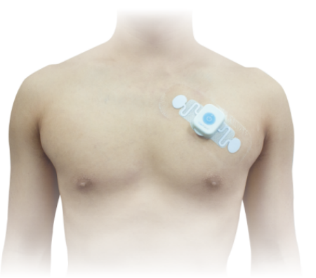 心电监护怎么贴单导联长程心电监测的临床应用（十）——康复科_https://www.jmylbn.com_新闻资讯_第10张