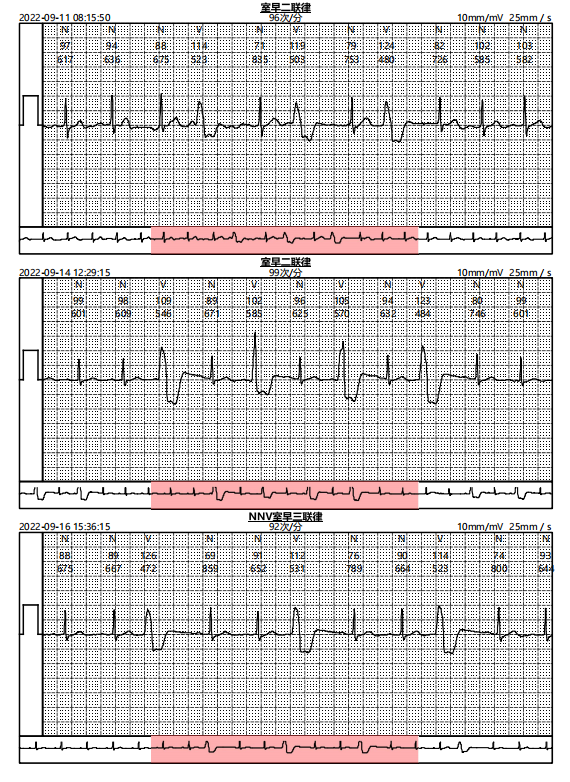 卡帕奇心电贴临床应用病例分享（九十五）I 心前区不适患者长程动态心电图检查病例分享 - 脉脉