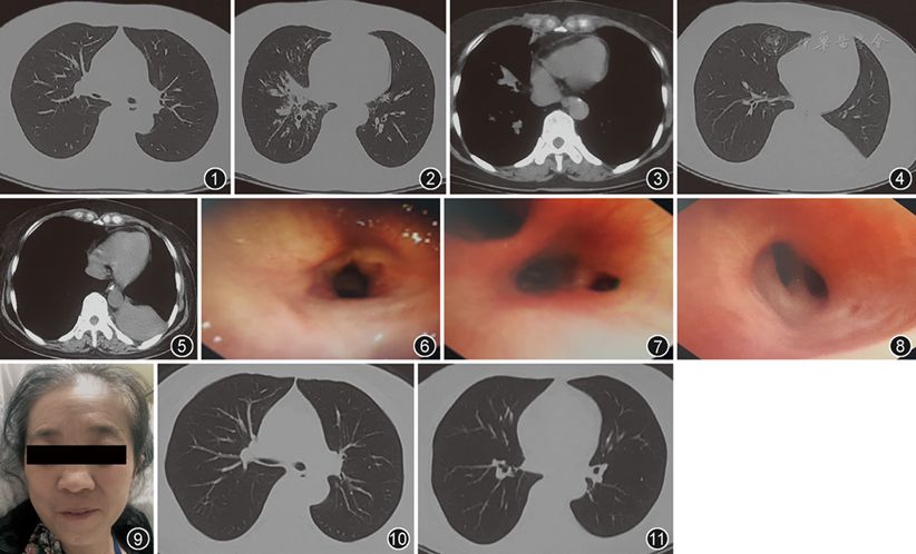 复发性多软骨炎致气道狭窄,咋治?_医学界-助力医生临床决策和职业成长