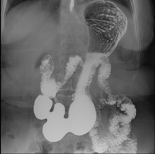 数字胃肠透视怎么做【三级医院创建 • 技术装备提升】数字胃肠检查，让胃肠疾病无处隐藏——我院引进多功能数字透视摄影系统_https://www.jmylbn.com_新闻资讯_第9张