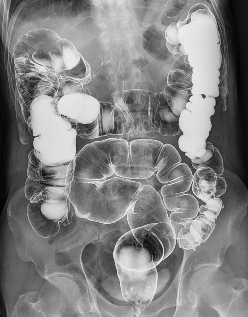 数字胃肠透视怎么做【三级医院创建 • 技术装备提升】数字胃肠检查，让胃肠疾病无处隐藏——我院引进多功能数字透视摄影系统_https://www.jmylbn.com_新闻资讯_第13张