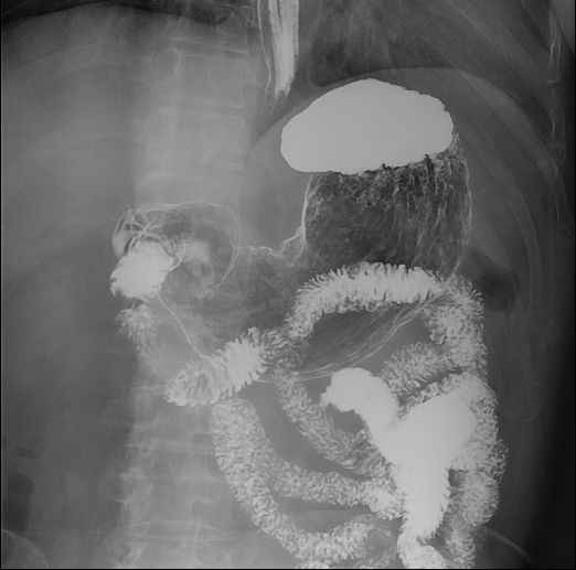 数字胃肠透视怎么做【三级医院创建 • 技术装备提升】数字胃肠检查，让胃肠疾病无处隐藏——我院引进多功能数字透视摄影系统_https://www.jmylbn.com_新闻资讯_第12张