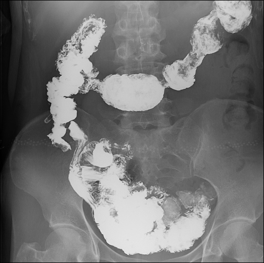 数字胃肠透视怎么做【三级医院创建 • 技术装备提升】数字胃肠检查，让胃肠疾病无处隐藏——我院引进多功能数字透视摄影系统_https://www.jmylbn.com_新闻资讯_第10张