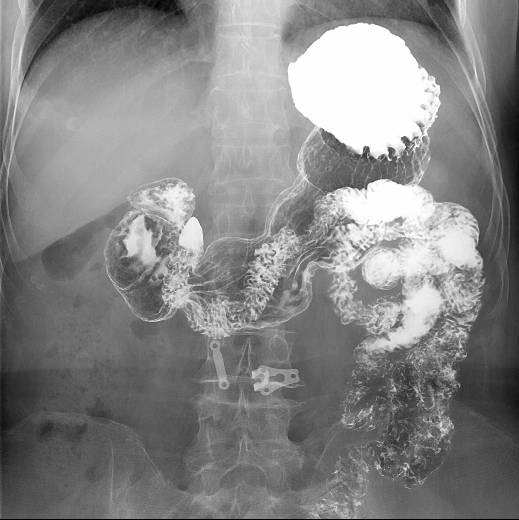 数字胃肠透视怎么做【三级医院创建 • 技术装备提升】数字胃肠检查，让胃肠疾病无处隐藏——我院引进多功能数字透视摄影系统_https://www.jmylbn.com_新闻资讯_第11张
