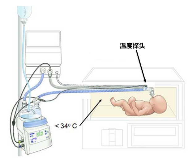 850湿化器怎么调呼吸湿化器：冷凝水的管理细节_https://www.jmylbn.com_新闻资讯_第13张