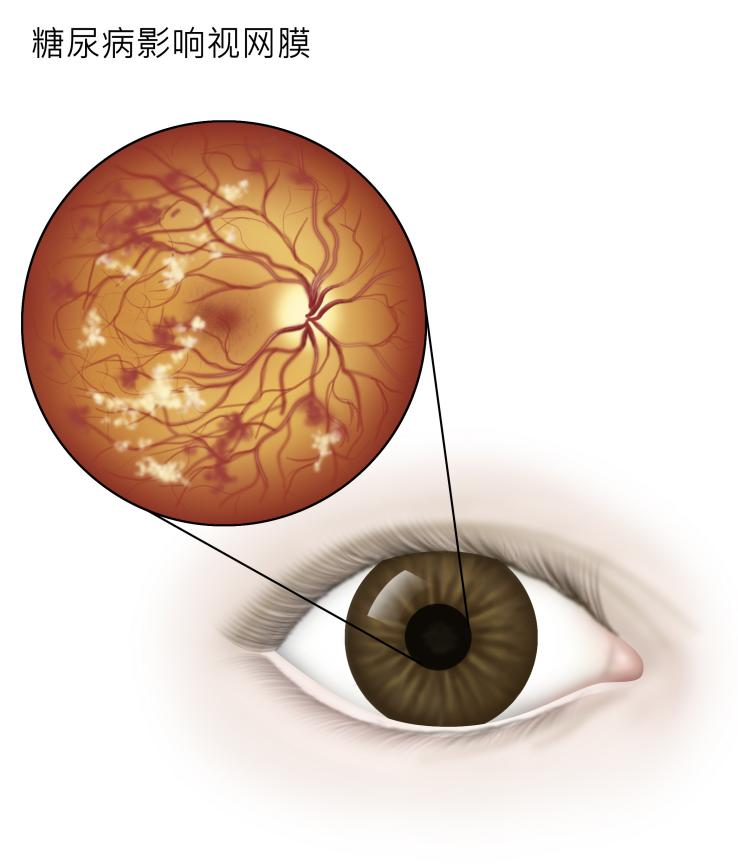 糖尿病有哪些危害？你真的知道吗？