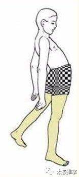 步态分析上曲线怎么解读常见异常步态分析_https://www.jmylbn.com_新闻资讯_第11张