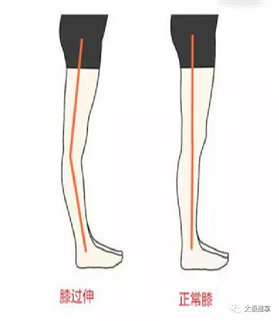 步态分析上曲线怎么解读常见异常步态分析_https://www.jmylbn.com_新闻资讯_第9张