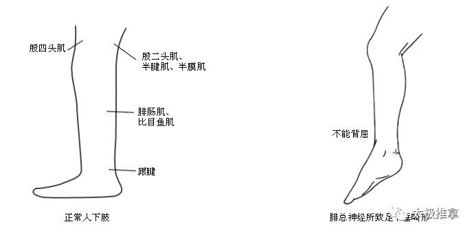 步态分析上曲线怎么解读常见异常步态分析_https://www.jmylbn.com_新闻资讯_第7张