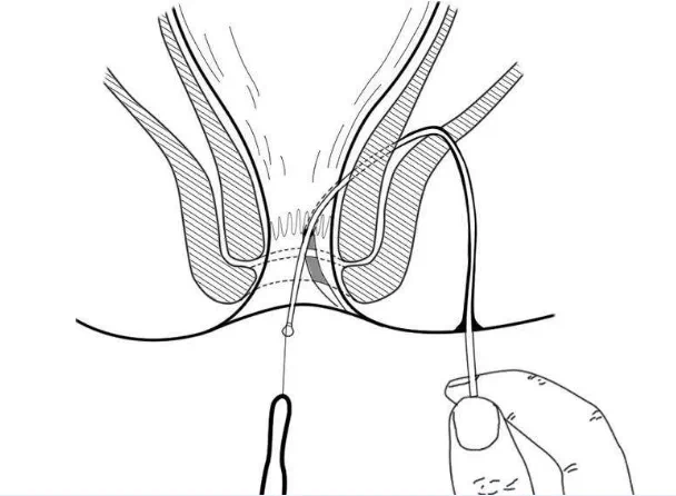肛瘘挂线手术示意图图片