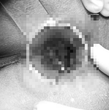 痔疮套扎吻合器怎么用“微创无痛”痔手术时代丨肛肠套扎吻合器首次在中医肛肠科痔手术中应用_https://www.jmylbn.com_新闻资讯_第8张